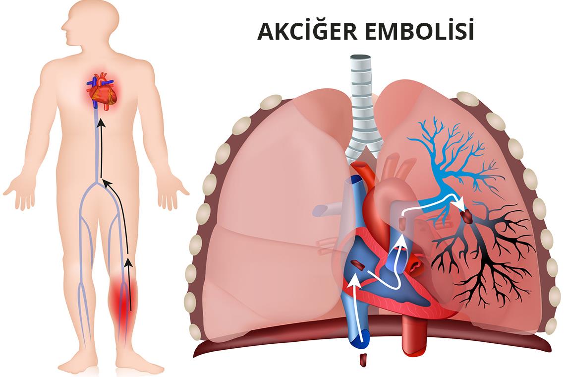 Akciğer Embolisi