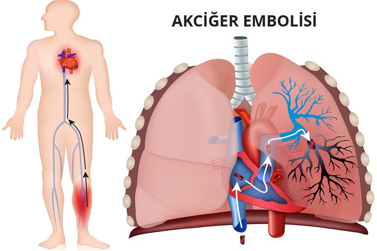 Pulmoner Emboli.